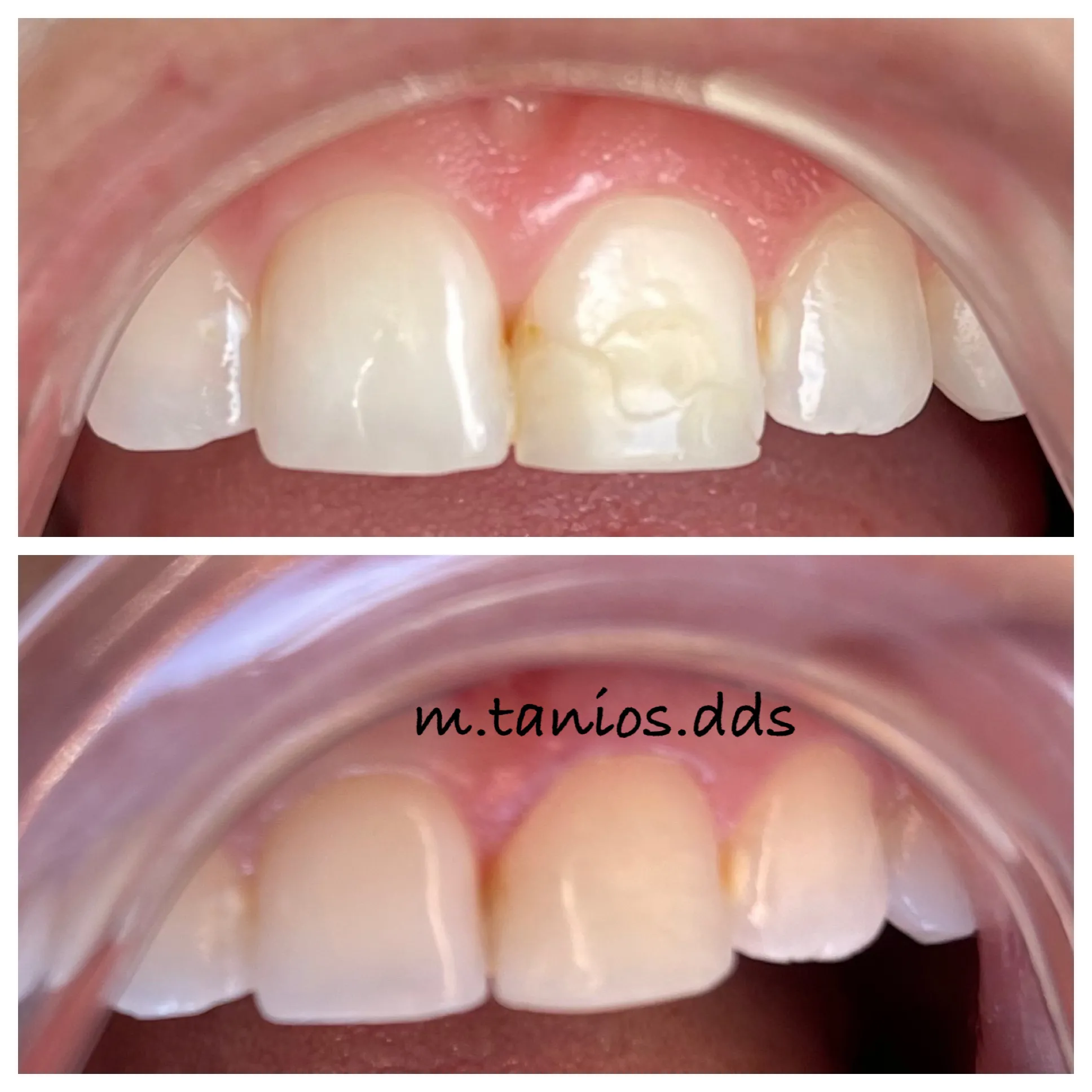 2 photos of before and after tooth-coloring