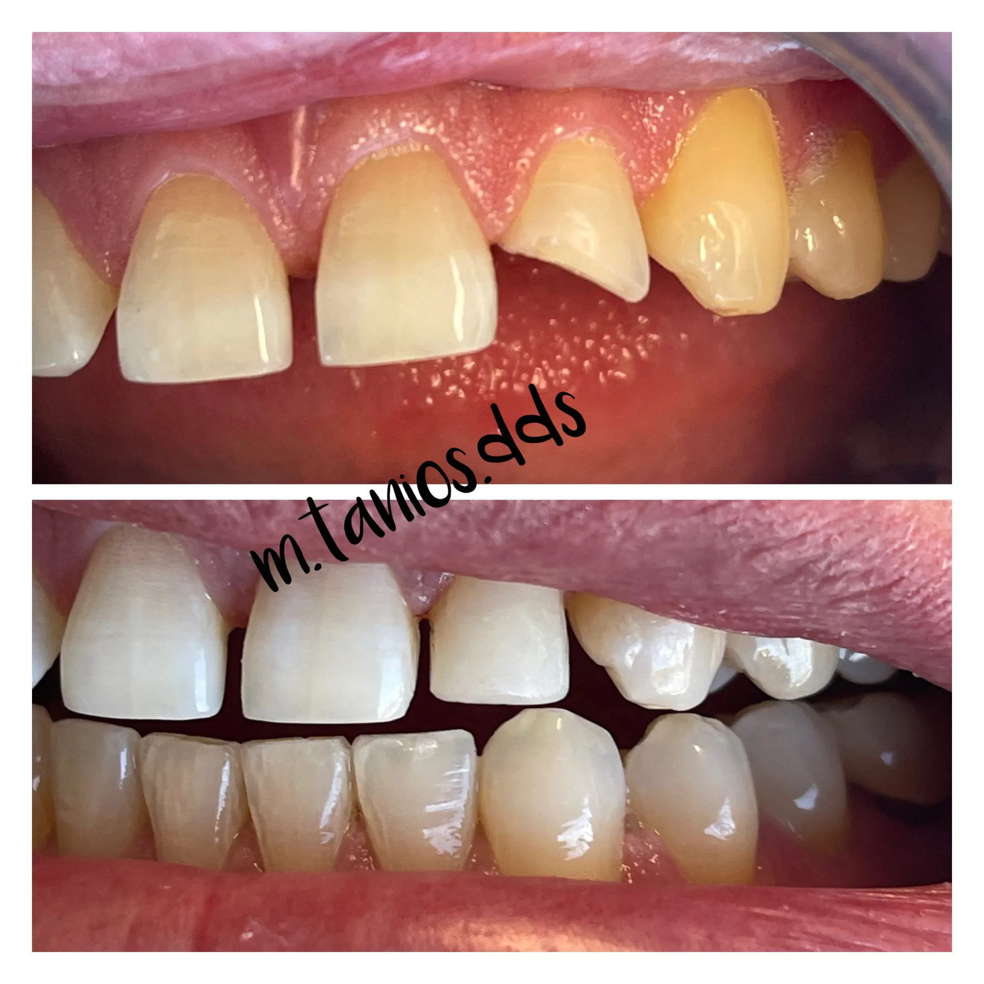 2 photos showing before and after tooth-coloring