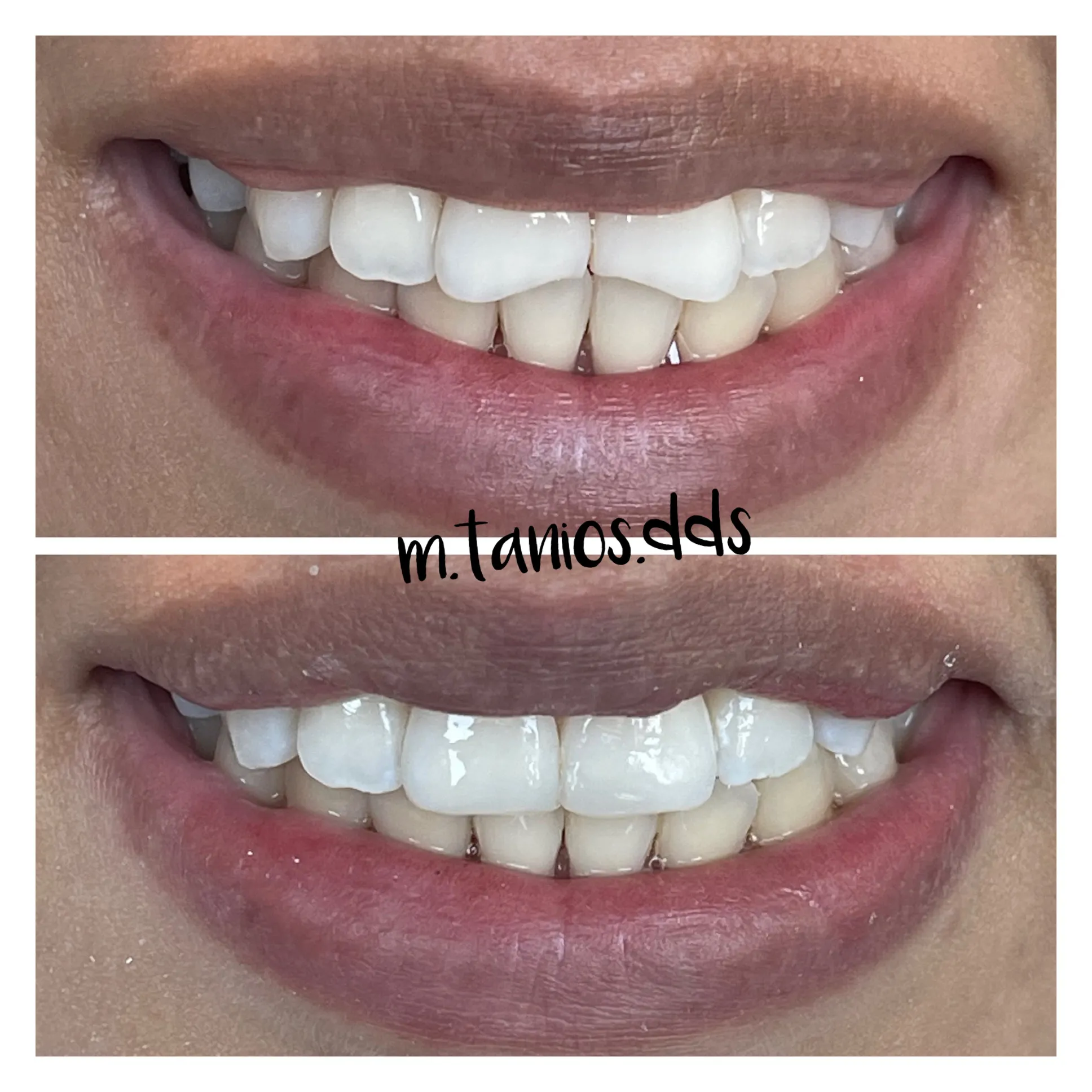 2 photos displaying before and after tooth-coloring