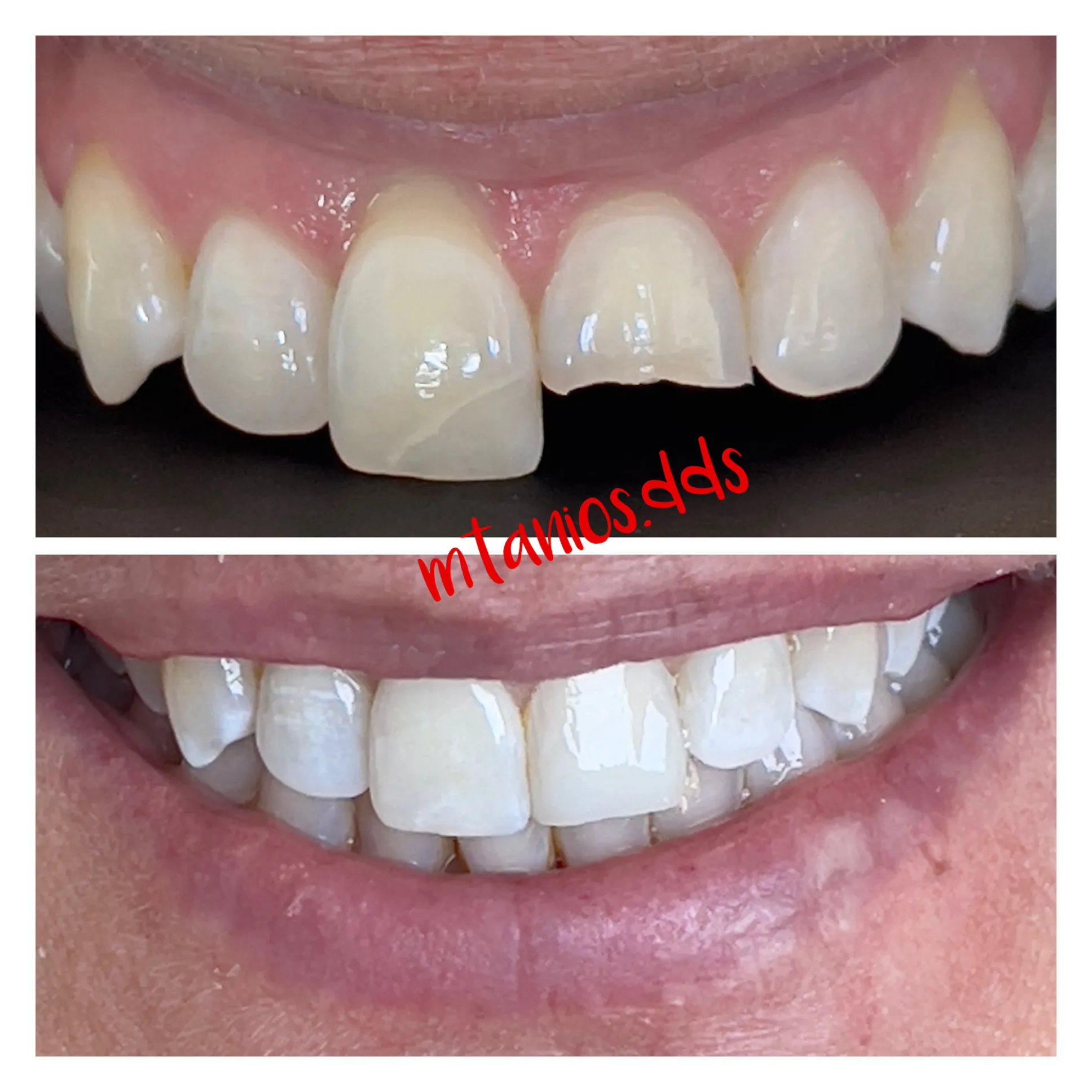 2 photos depicting before and after tooth-coloring