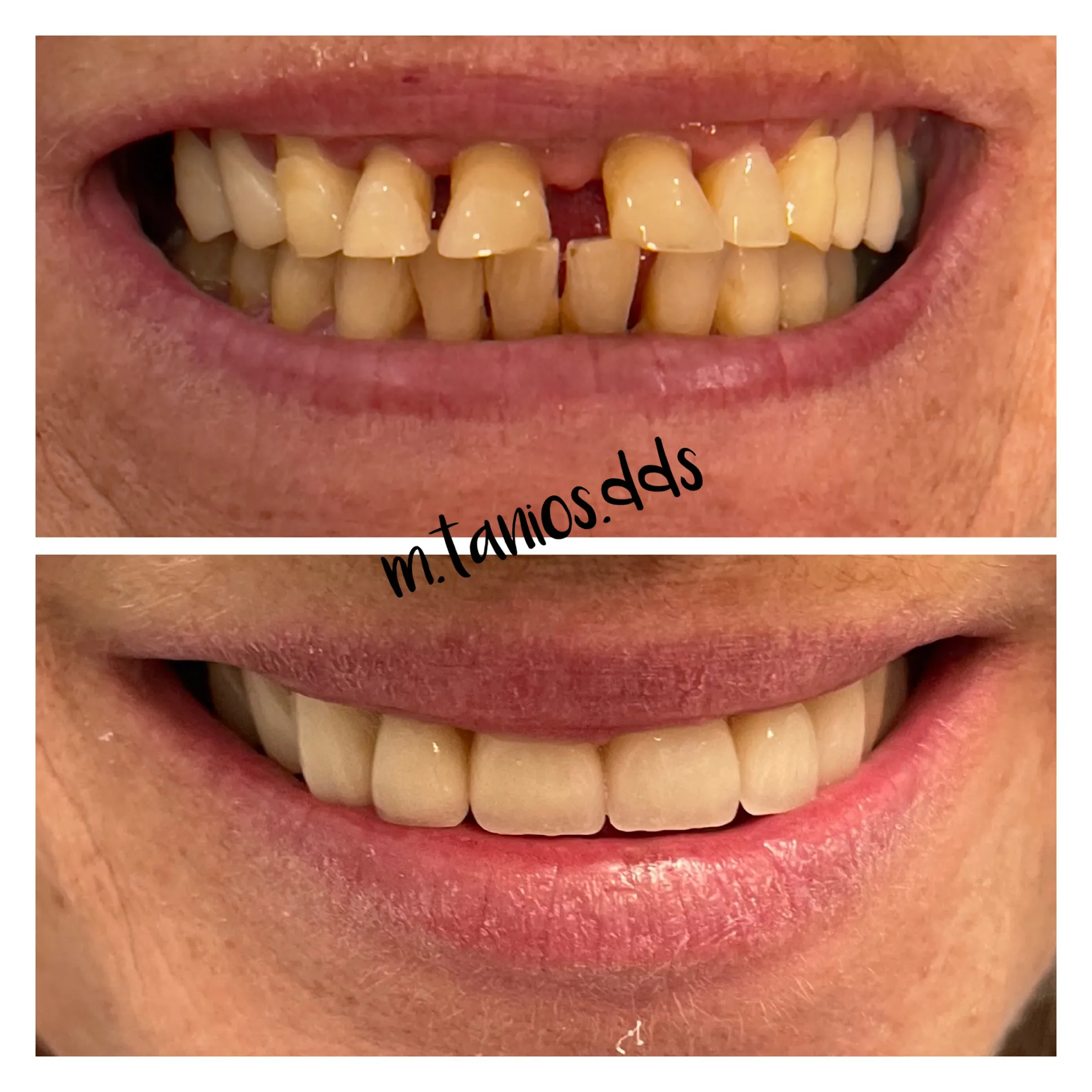 2 photos displaying before and after crowns