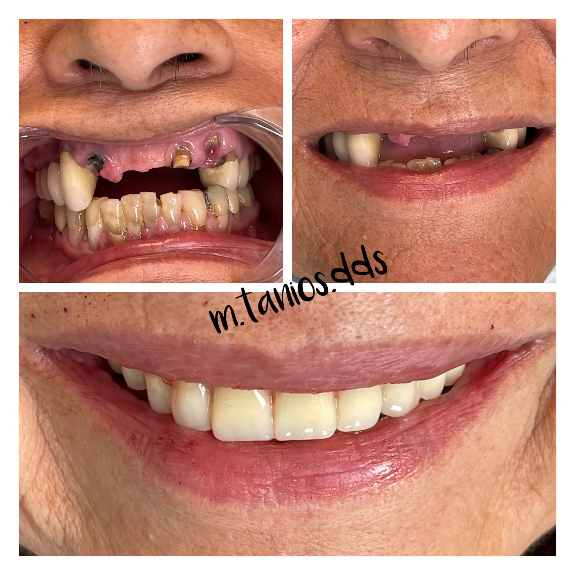 3 pictures showing before and after dentures