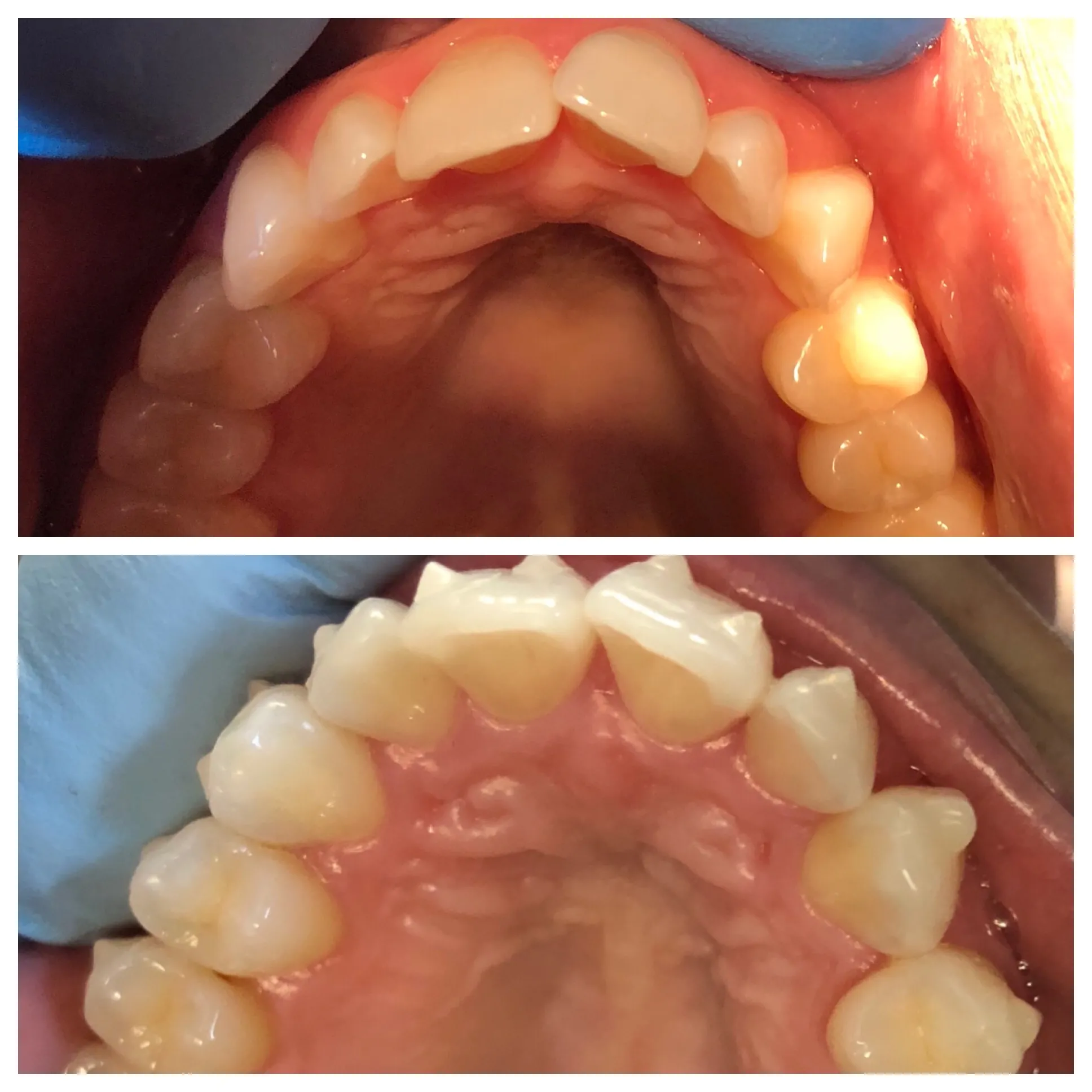 2 photos displaying open mouth before and after invisalign