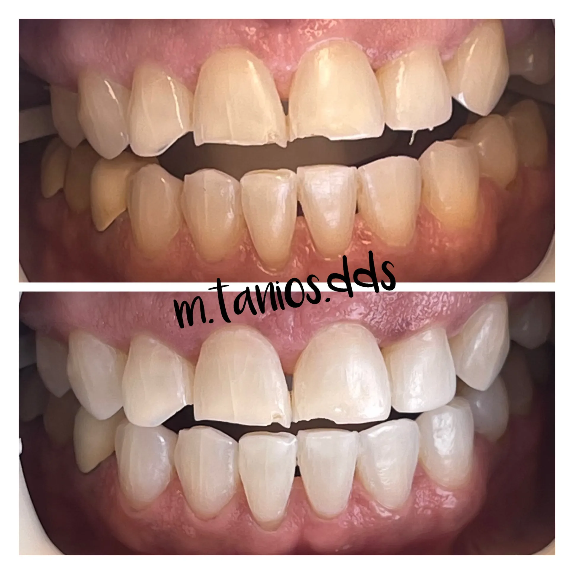 2 pictures before and after teeth whitening