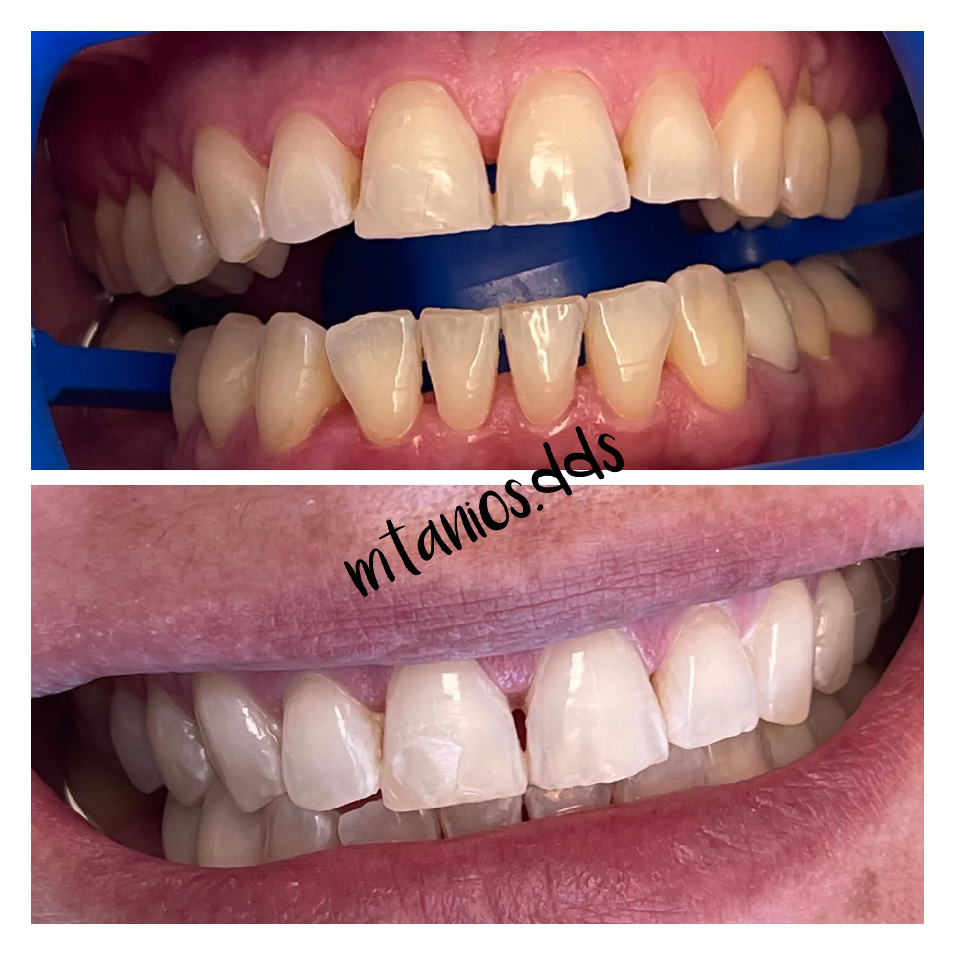 2 pictures displaying before and after teeth whitening