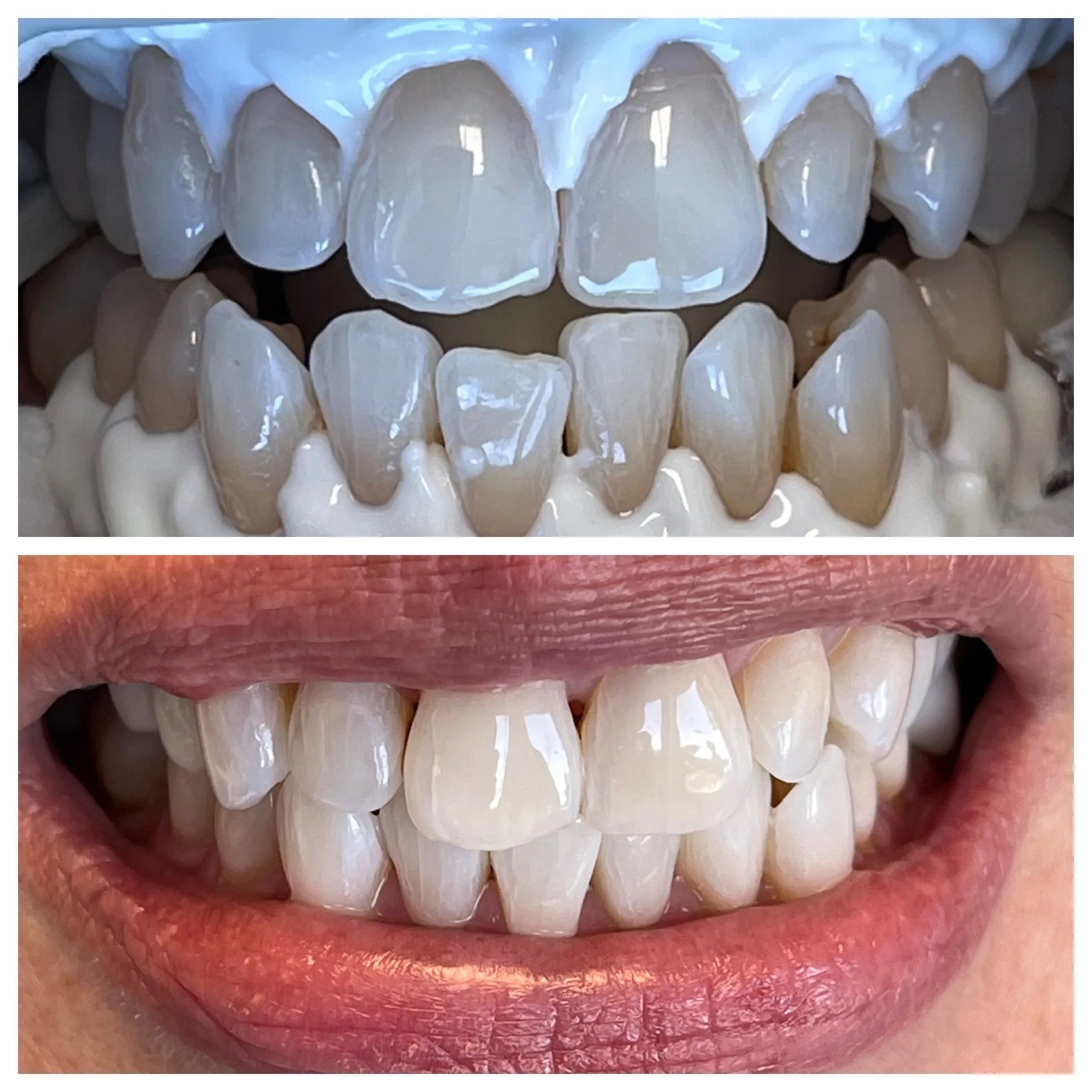 2 pictures of before and after teeth whitening